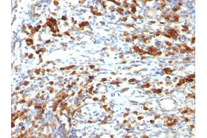 Formalin-fixed, paraffin-embedded human Lymphoma stained with CD79a Mouse Monoclonal Antibody (IGA/764) (CD79a anticorps)