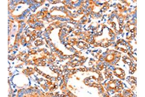 The image on the left is immunohistochemistry of paraffin-embedded Human thyroid cancer tissue using ABIN7192314(SEPT4 Antibody) at dilution 1/50, on the right is treated with synthetic peptide. (Septin 4 anticorps)