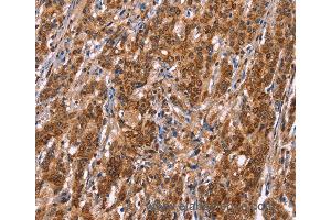 Immunohistochemistry of Human thyroid cancer using TDP2 Polyclonal Antibody at dilution of 1:40
