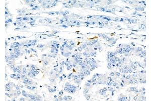 ABIN6264974 and ABIN6276799 at 1/100 staining Human liver cancer by IHC-P. (SELPLG anticorps  (N-Term))