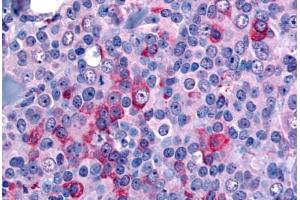 Anti-NANP antibody  ABIN1049088 IHC staining of human breast, carcinoma. (NANP anticorps  (N-Term))