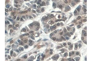 IHC-P analysis of Human Pancreatic cancer Tissue, with DAB staining. (C5A anticorps  (AA 678-751))