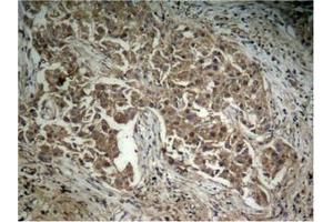 Immunohistochemical analysis of paraffin-embedded human lung carcinoma tissue, using Akt (Phospho-Thr308) Antibody. (AKT1 anticorps  (pThr308))