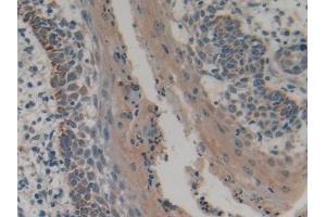 Detection of PLA2G4 in Human Skin cancer Tissue using Polyclonal Antibody to Cytosolic Phospholipase A2 (PLA2G4)