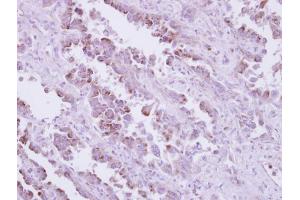 IHC-P Image Immunohistochemical analysis of paraffin-embedded human lung cancer, using TLR9, antibody at 1:250 dilution. (TLR9 anticorps  (N-Term))