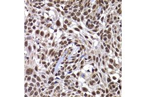 Immunohistochemistry of paraffin-embedded human well-differentiated squamous skin carcinoma using DNAJB6 antibody. (DNAJB6 anticorps)