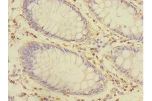 Immunohistochemistry of paraffin-embedded human colon cancer using ABIN7149052 at dilution of 1:100