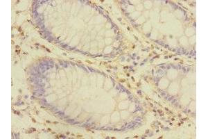 Immunohistochemistry of paraffin-embedded human colon cancer using ABIN7149052 at dilution of 1:100 (CRIP1 anticorps  (AA 1-77))