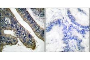 Immunohistochemistry analysis of paraffin-embedded human colon carcinoma, using c-PLA2 (Phospho-Ser505) Antibody. (C-PLA2 (AA 471-520), (pSer505) anticorps)