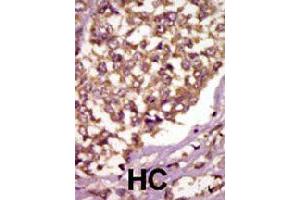 Formalin-fixed and paraffin-embedded human hepatocellular carcinoma tissue reacted with BMX polyclonal antibody  , which was peroxidase-conjugated to the secondary antibody, followed by AEC staining. (BMX anticorps  (Internal Region))