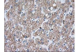 Immunohistochemical staining of paraffin-embedded Carcinoma of Human liver tissue using anti-MTRF1L mouse monoclonal antibody. (MTRF1L anticorps)