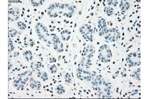 Immunohistochemical staining of paraffin-embedded breast tissue using anti-CHEK2 mouse monoclonal antibody. (CHEK2 anticorps)