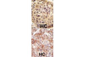 (TOP) Formalin-fixed and paraffin-embedded human hepatocellular carcinoma reacted with UBB polyclonal antibody  , which was peroxidase-conjugated to the secondary antibody, followed by DAB staining. (Ubiquitin B anticorps  (N-Term))