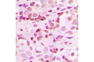 Immunohistochemical analysis of SP1 (pT453) staining in human breast cancer formalin fixed paraffin embedded tissue section.