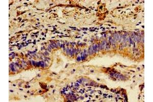 Immunohistochemistry of paraffin-embedded human lung cancer using ABIN7157824 at dilution of 1:100 (LCT anticorps  (AA 983-1252))