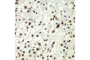 Immunohistochemistry of paraffin-embedded human kidney cancer using SF3B2 antibody.