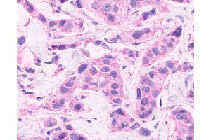 Anti-CELSR2 antibody IHC of human Breast, Carcinoma. (CELSR2 anticorps  (C-Term))