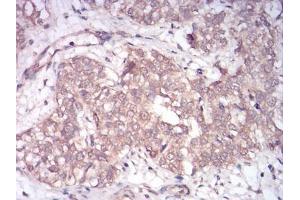 Immunohistochemical analysis of paraffin-embedded bladder cancer tissues using Rab13 mouse mAb with DAB staining.