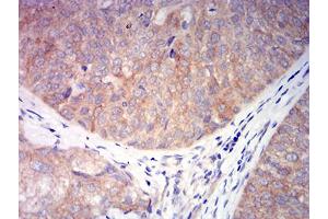 Immunohistochemical analysis of paraffin-embedded bladder cancer tissues using CHRNA6 mouse mAb with DAB staining. (CHRNA6 anticorps  (AA 26-239))
