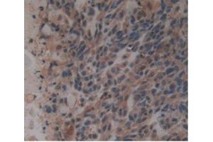 Detection of GDF3 in Human Lung Cancer Tissue using Monoclonal Antibody to Growth Differentiation Factor 3 (GDF3) (GDF3 anticorps  (AA 251-364))