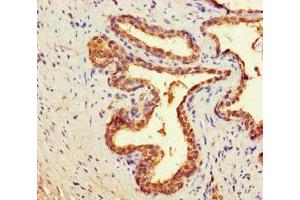 Immunohistochemistry of paraffin-embedded human prostate cancer using ABIN7149400 at dilution of 1:100 (CNDP2 anticorps  (AA 2-475))