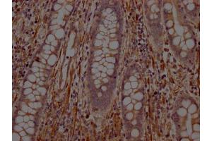 IHC image of ABIN7127784 diluted at 1:100 and staining in paraffin-embedded human colon cancer performed on a Leica BondTM system.