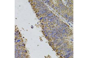Immunohistochemistry of paraffin-embedded human colon carcinoma using ALDH1A1 antibody.