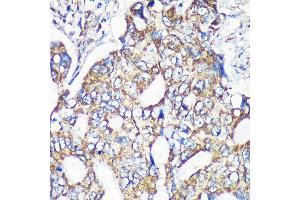 Immunohistochemistry of paraffin-embedded Human colon carcinoma using MRPS35 Rabbit pAb (ABIN7268587) at dilution of 1:100 (40x lens).