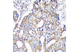 Immunohistochemistry of paraffin-embedded Human colon carcinoma using MRPS35 Rabbit pAb (ABIN7268587) at dilution of 1:100 (40x lens). (MRPS35 anticorps  (AA 1-323))