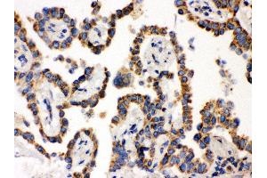 Anti- WASP Picoband antibody, IHC(P) IHC(P): Human Lung Cancer Tissue