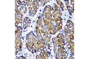 Immunohistochemistry of paraffin-embedded Human liver cancer using [KO Validated] NSDHL Rabbit pAb (ABIN7268794) at dilution of 1:100 (40x lens).