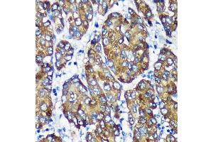 Immunohistochemistry of paraffin-embedded Human liver cancer using [KO Validated] NSDHL Rabbit pAb (ABIN7268794) at dilution of 1:100 (40x lens). (NSDHL anticorps  (AA 1-240))