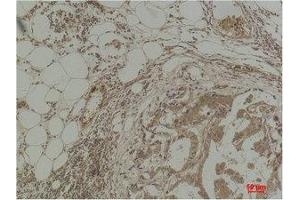 Immunohistochemical analysis of paraffin-embedded Human Breast Carcinoma using Pan Methylated Lysine Monoclonal Antibody. (Methylated Lysine (pan) anticorps)