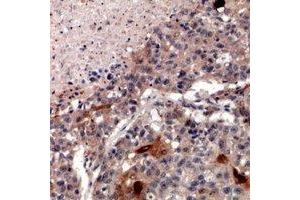 Immunohistochemical analysis of ZNT2 staining in human lung cancer formalin fixed paraffin embedded tissue section. (SLC30A2 anticorps)
