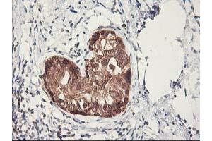 Immunohistochemical staining of paraffin-embedded Adenocarcinoma of Human breast tissue using anti-RBBP7 mouse monoclonal antibody. (RBBP7 anticorps)