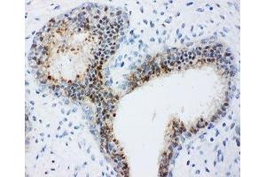 IHC-P: Bub3 antibody testing of human breast cancer tissue (BUB3 anticorps  (Middle Region))