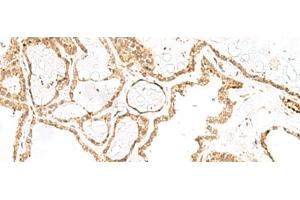 Immunohistochemistry of paraffin-embedded Human thyroid cancer tissue using RPP14 Polyclonal Antibody at dilution of 1:60(x200) (RPP14 anticorps)