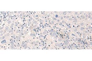 Immunohistochemistry of paraffin-embedded Human cervical cancer tissue using THOP1 Polyclonal Antibody at dilution of 1:35(x200)