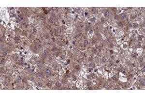 ABIN6273963 at 1/100 staining Human liver cancer tissue by IHC-P. (OR7E24 anticorps)