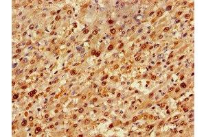 Immunohistochemistry of paraffin-embedded human liver cancer using ABIN7173917 at dilution of 1:100 (TP53INP1 anticorps  (AA 138-205))