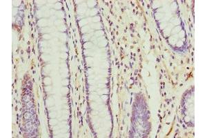 Immunohistochemistry of paraffin-embedded human colon cancer using ABIN7173103 at dilution of 1:100 (TMEM177 anticorps  (AA 219-311))