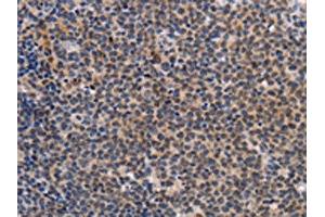 The image on the left is immunohistochemistry of paraffin-embedded Human Lymphoma tissue using ABIN7191963(POU4F1 Antibody) at dilution 1/25, on the right is treated with synthetic peptide. (POU4F1 anticorps)