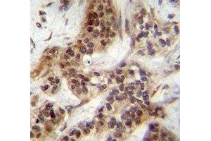 FOXA2 antibody immunohistochemistry analysis in formalin fixed and paraffin embedded human bladder carcinoma.