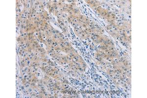 Immunohistochemistry of Human gastric cancer using AGAP2 Polyclonal Antibody at dilution of 1:30 (AGAP2 anticorps)