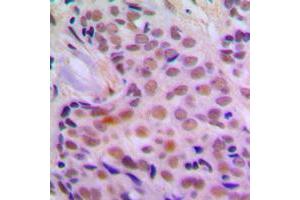 Immunohistochemical analysis of CHK2 staining in human breast cancer formalin fixed paraffin embedded tissue section.