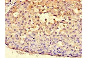 Immunohistochemistry of paraffin-embedded human breast cancer using ABIN7170815 at dilution of 1:100 (HSPA9 anticorps  (AA 458-679))