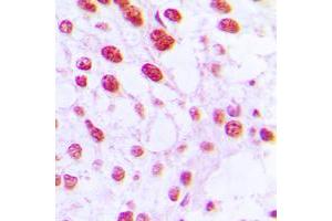 Immunohistochemical analysis of DNA Polymerase beta staining in human breast cancer formalin fixed paraffin embedded tissue section.