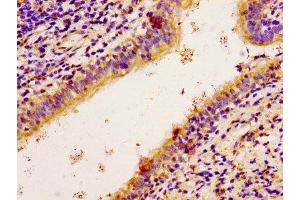 Immunohistochemistry of paraffin-embedded human lung cancer using ABIN7168176 at dilution of 1:100 (RPS6KA2 anticorps  (AA 228-395))