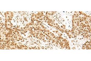 Immunohistochemistry of paraffin-embedded Human ovarian cancer tissue using NHP2 Polyclonal Antibody at dilution of 1:55(x200) (NHP2 anticorps)