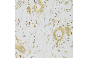 Immunohistochemistry of paraffin-embedded human liver cancer using CASP2 Antibody (ABIN2561574) at dilution of 1:100 (40x lens). (Caspase 2 anticorps)